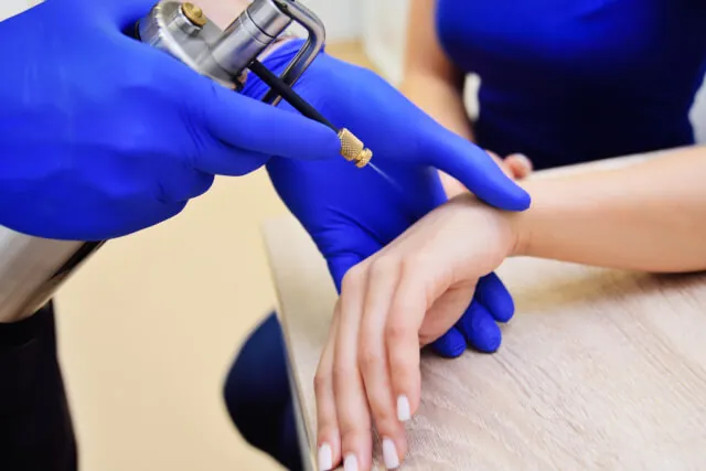 Cryotherapy being applied to the back of a patient’s hand