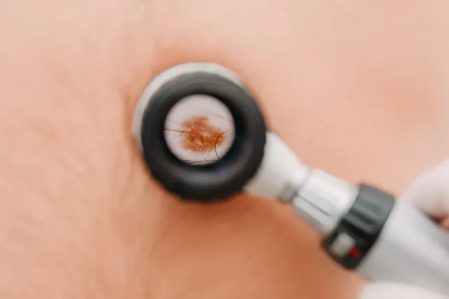 A mole being examined with a dermatoscope