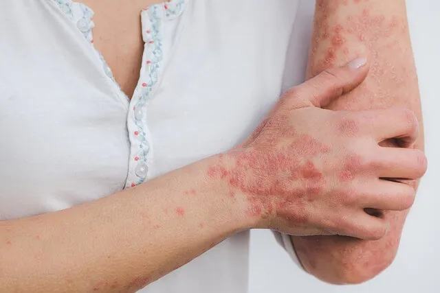 Psoriasis patches on a woman’s forearm and hand